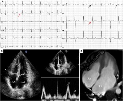 Case report: Rare restrictive cardiomyopathy with ventricular fibrillation as initial symptom rescued by automatic external defibrillator in a pediatric patient